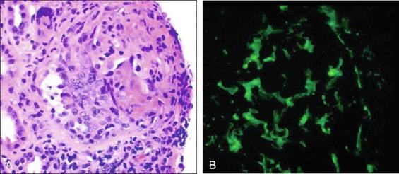 Fig. 39.5, Renal Biopsy in a Patient With Granulomatosis With Polyangiitis (GPA; Same Patient as in Fig. 39.4 ) With Rapidly Progressive Glomerulonephritis.