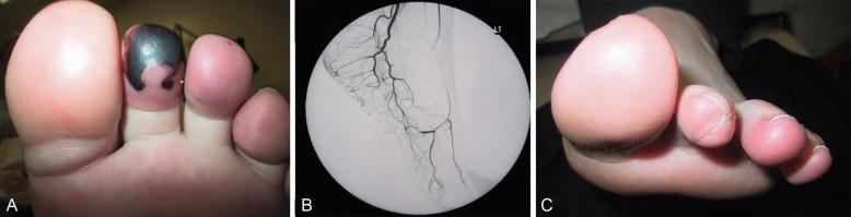 Fig. 39.6, Gangrenous Toe in a Patient With Granulomatosis With Polyangiitis.