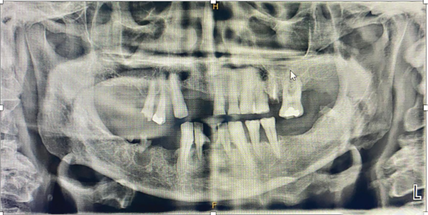 Figure 8.4, An orthopantomogram showing generalized poor dentition with widespread caries and numerous periapical abscesses, most notably at 1′3, 2′4, 4′2, and 4′4. The patient received a preoperative dental clearance.