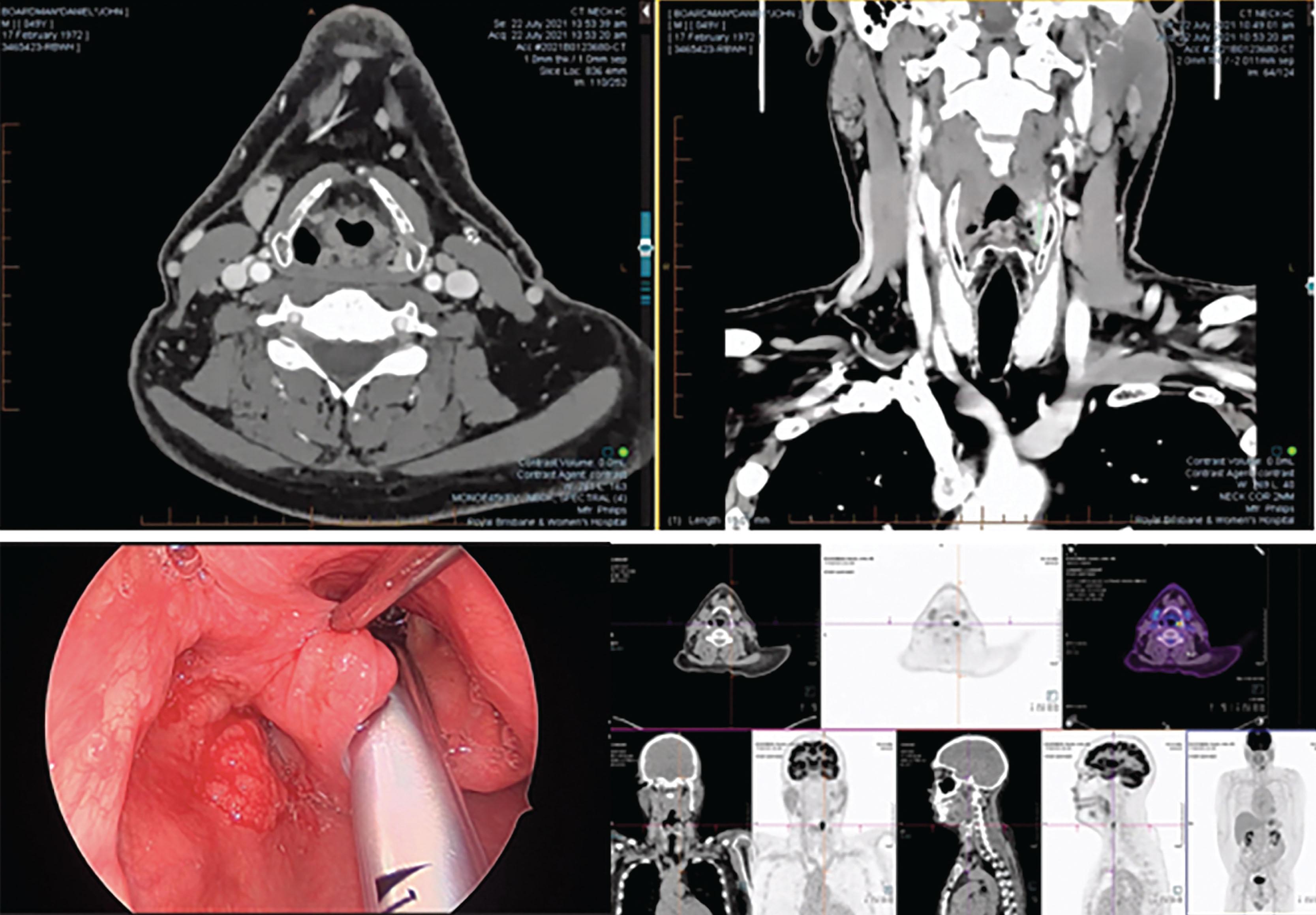 Figure 8.5, Routine radiological workup of a cT2NM0 hyphopharyngeal squamous cell carcinoma in an elderly male smoker, including CT, endoscopy with biopsy, and PET/CT.
