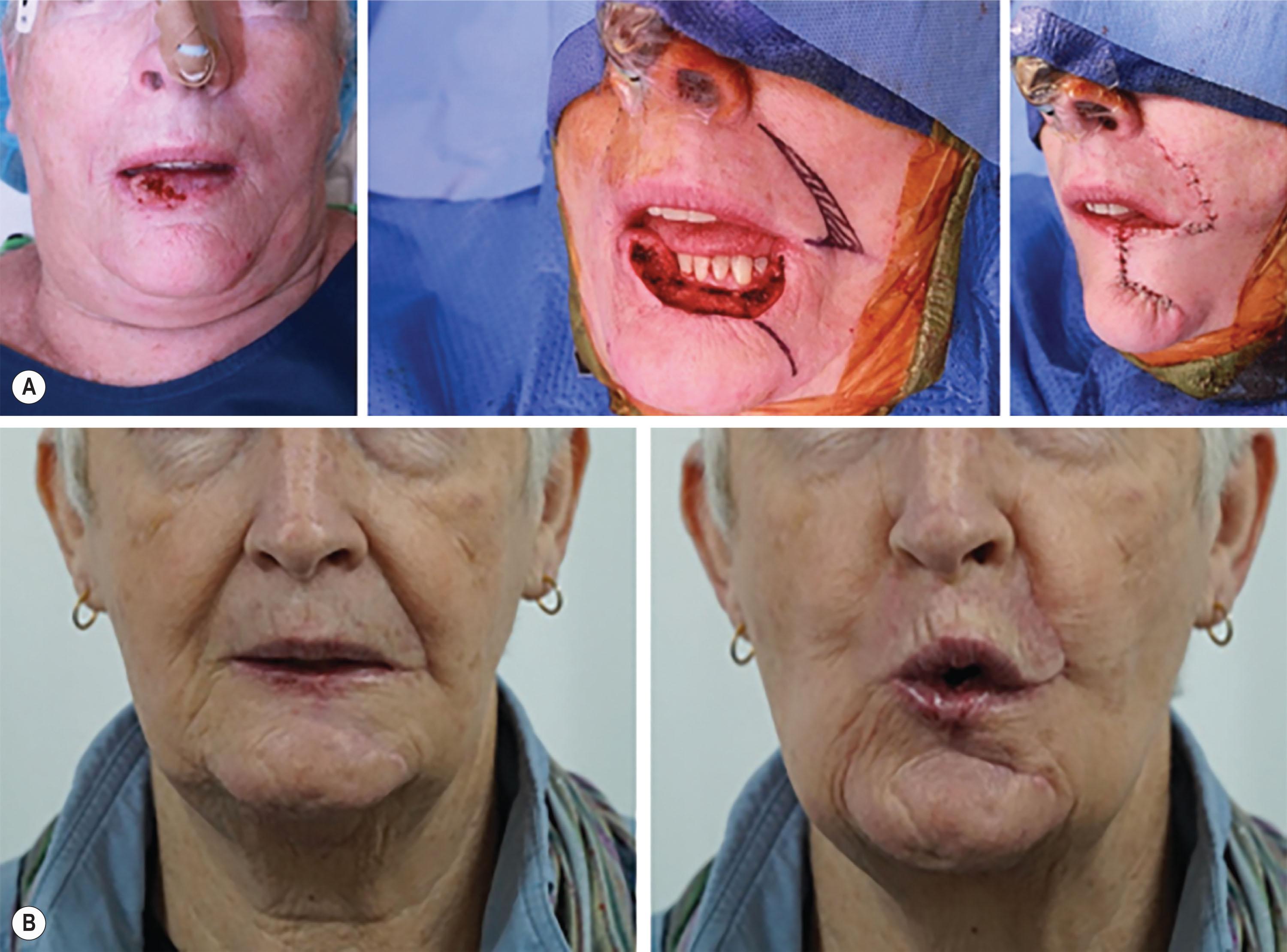 Figure 8.7, (A) Subtotal left lower lip defect following resection of a T3N0 squamous cell carcinoma with reconstruction with an ipsilateral Webster–Bernard flap. (B) Postoperative aesthetic and functional result at 3 months.