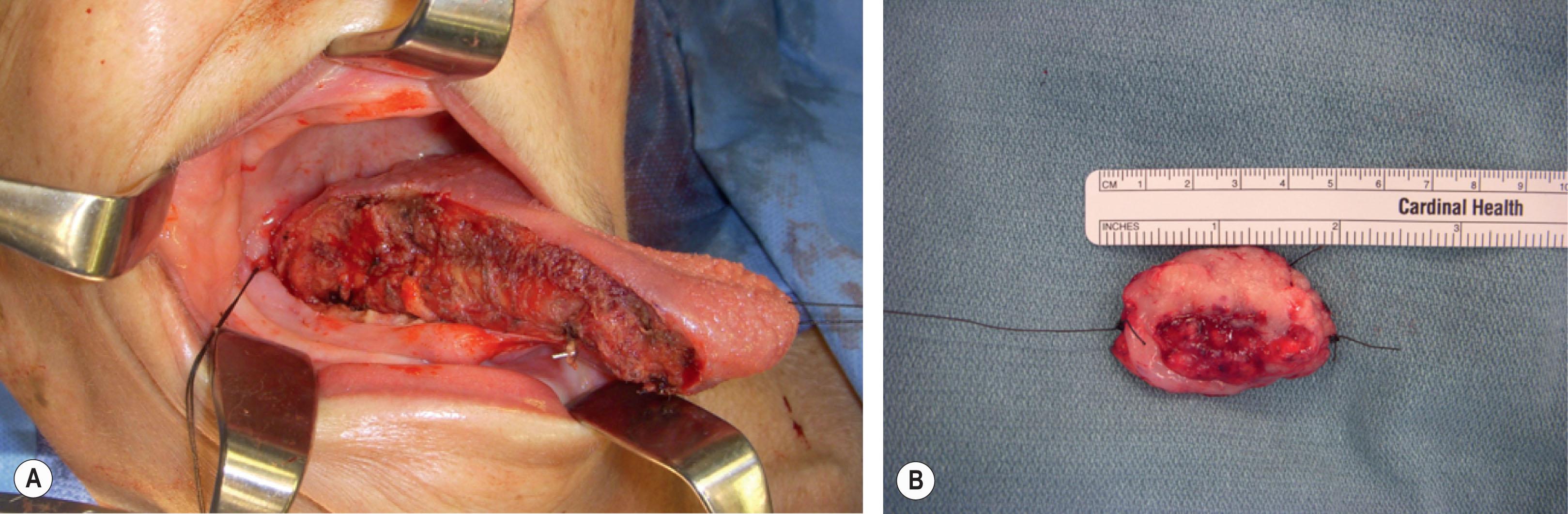 Figure 8.8, (A) Transoral resection of a lateral tongue border squamous cell carcinoma. Note access to the posterior limit of the oral cavity. (B) The surgical specimen demonstrating that adequate resection margins are obtainable with this technique, which avoids the morbidity of mandibulotomy.