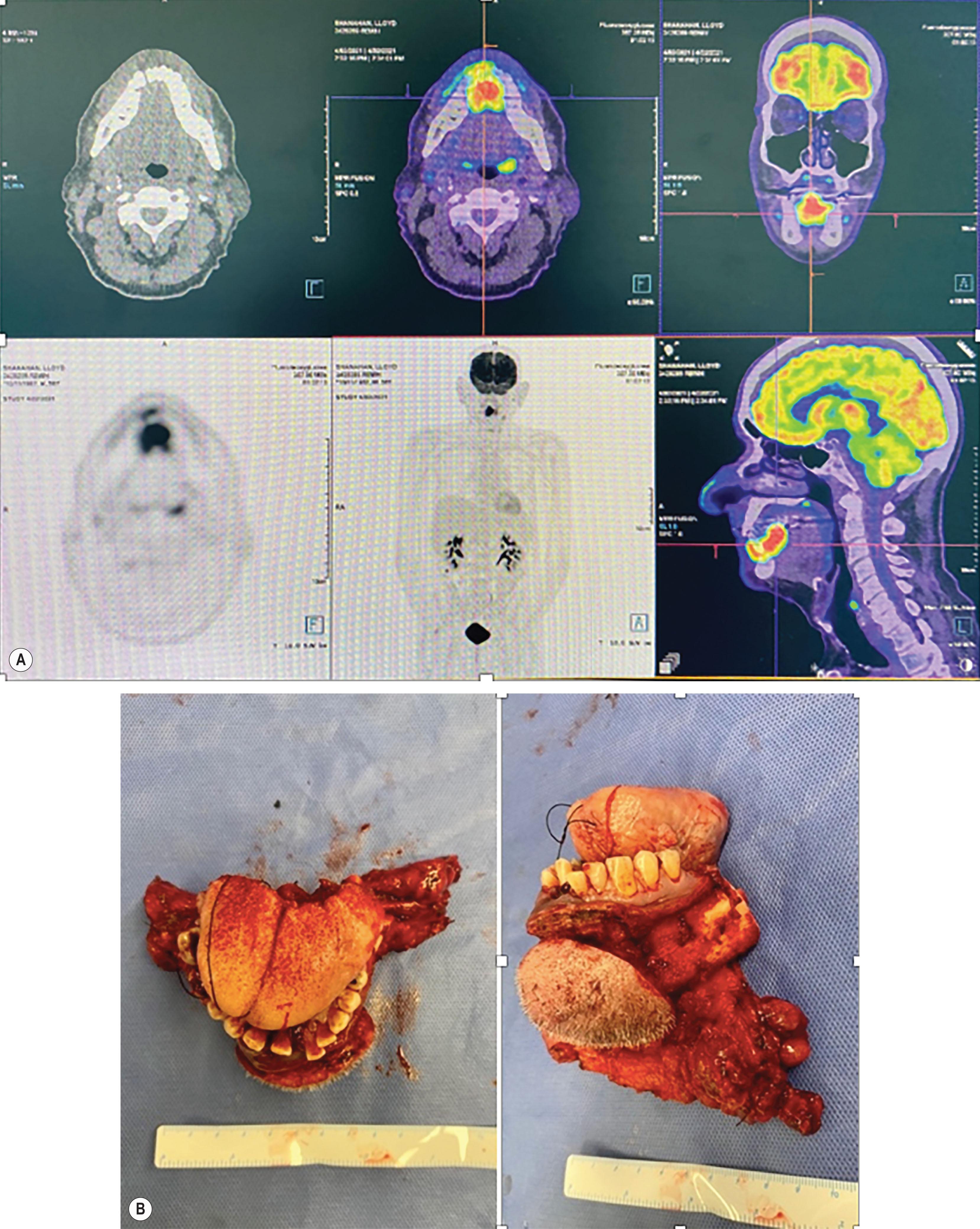 Figure 8.9, (A) T4aN0M0 p16-negative squamous cell carcinoma centered in the floor of mouth showing intensive FDG uptake (SUVmax 18.7) with local extension to the superior aspect of mandible anteriorly and anteroinferior aspect of the tongue posteriorly. (B) The resection including an anterior mandibulectomy, anterior tongue, floor of mouth with suprahyoid muscles and skin of the chin is associated with permanent and severe speech and swallow morbidity. Reconstruction was uncomplicated with a composite free fibula flap, however percutaneous endoscopic gastrostomy feeding was required postoperatively for at least 6 months.