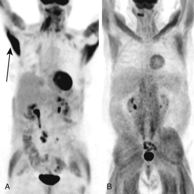 FIGURE 4.1, 2-Deoxy-2-fluoro-D-glucose ( 18 F-FDG) uptake in skeletal muscles. A, Coronal attenuation–corrected positron emission tomography (PET) image demonstrating increased 18 F-FDG uptake in contracting skeletal muscles, best seen in latissimus dorsi muscles (arrow) . B, Coronal attenuation–corrected PET image demonstrating diffusely 18 F-FDG–avid muscles in a diabetic patient treated with insulin.