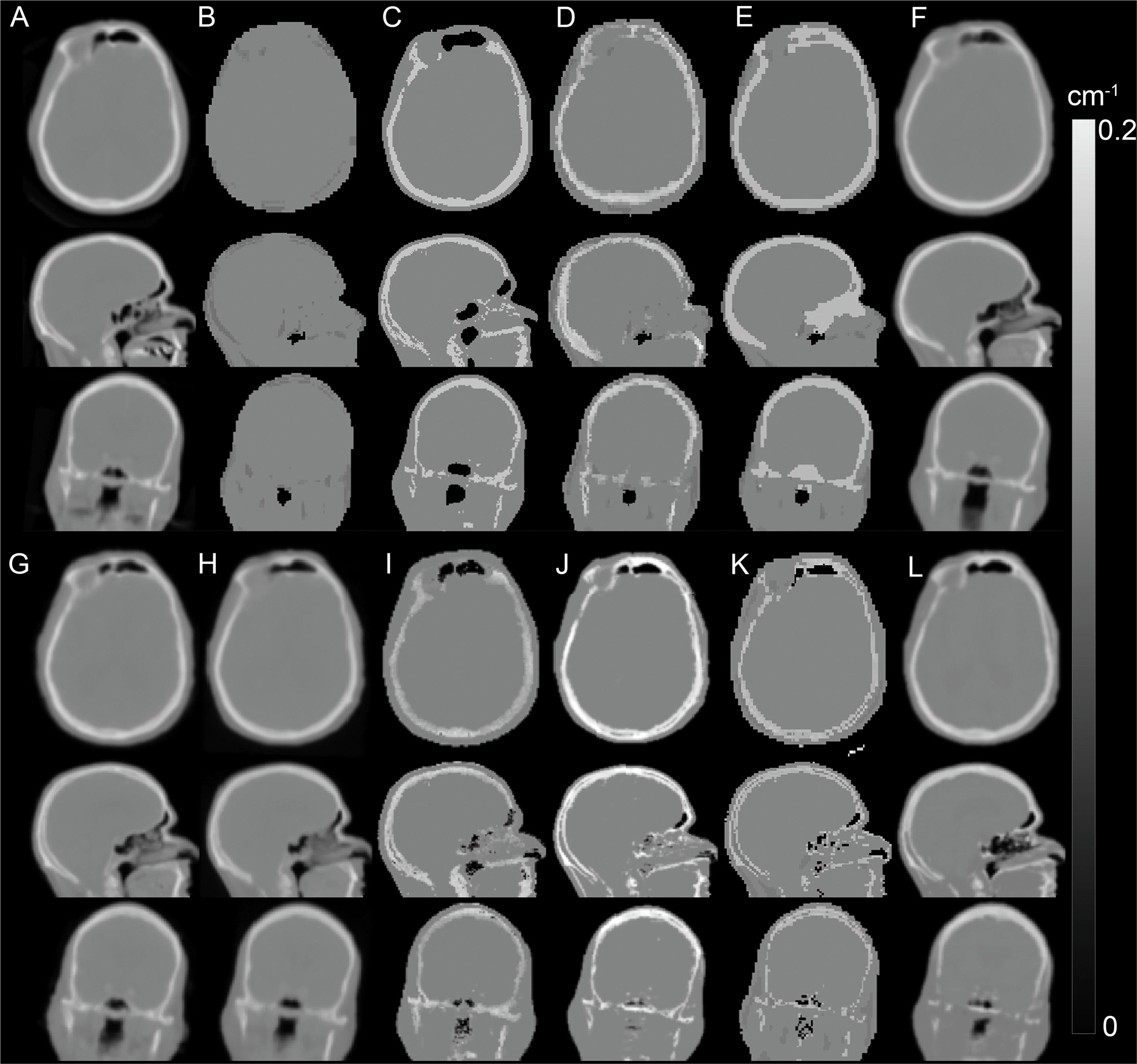 Figure 1.2, Head MR-based attenuation correction methods. Attenuation maps for a representative subject generated with different methods: (A) CT, (B) Dixon, (C) UTE, (D) Segbone, (E) Ontario, (F) Boston, (G) UCL, (H) MaxProb, (I) MLAA, (J) Munich, (K) CAR-RiDR, (L) RESOLUTE.