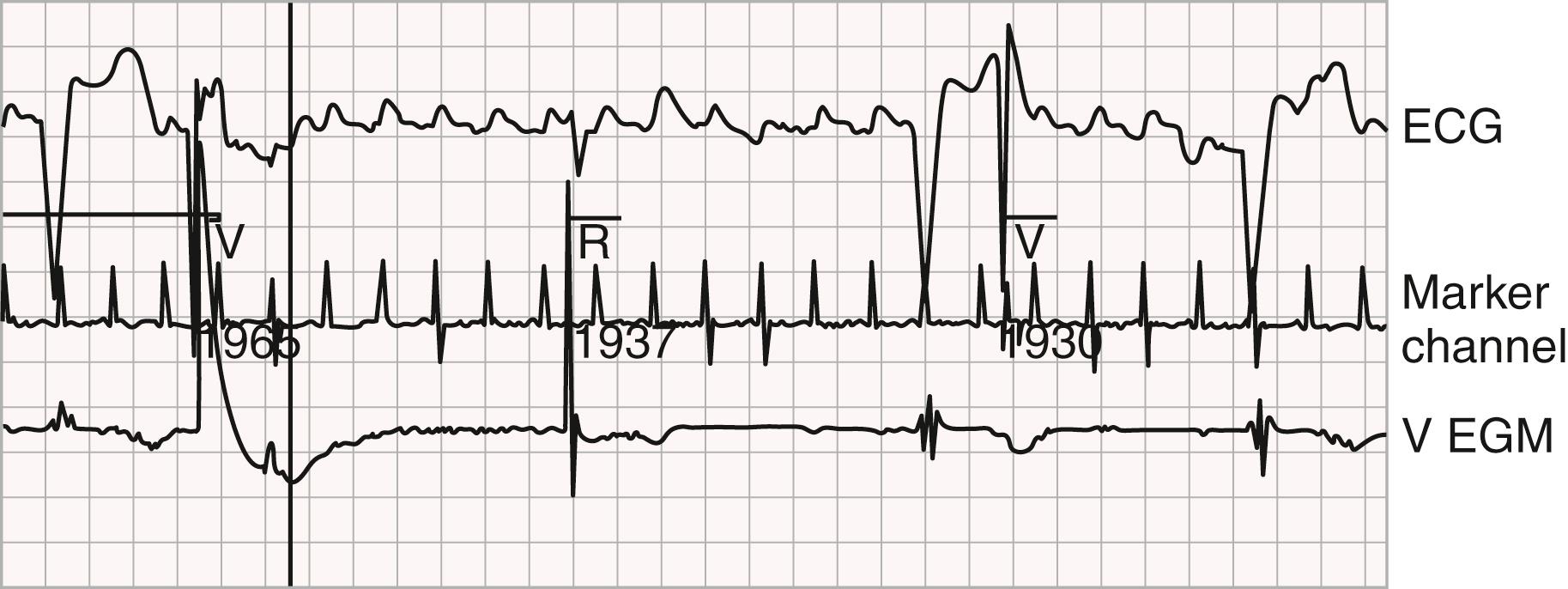 Pacemakers and Implantable Cardioverter-Defibrillators - Clinical Tree