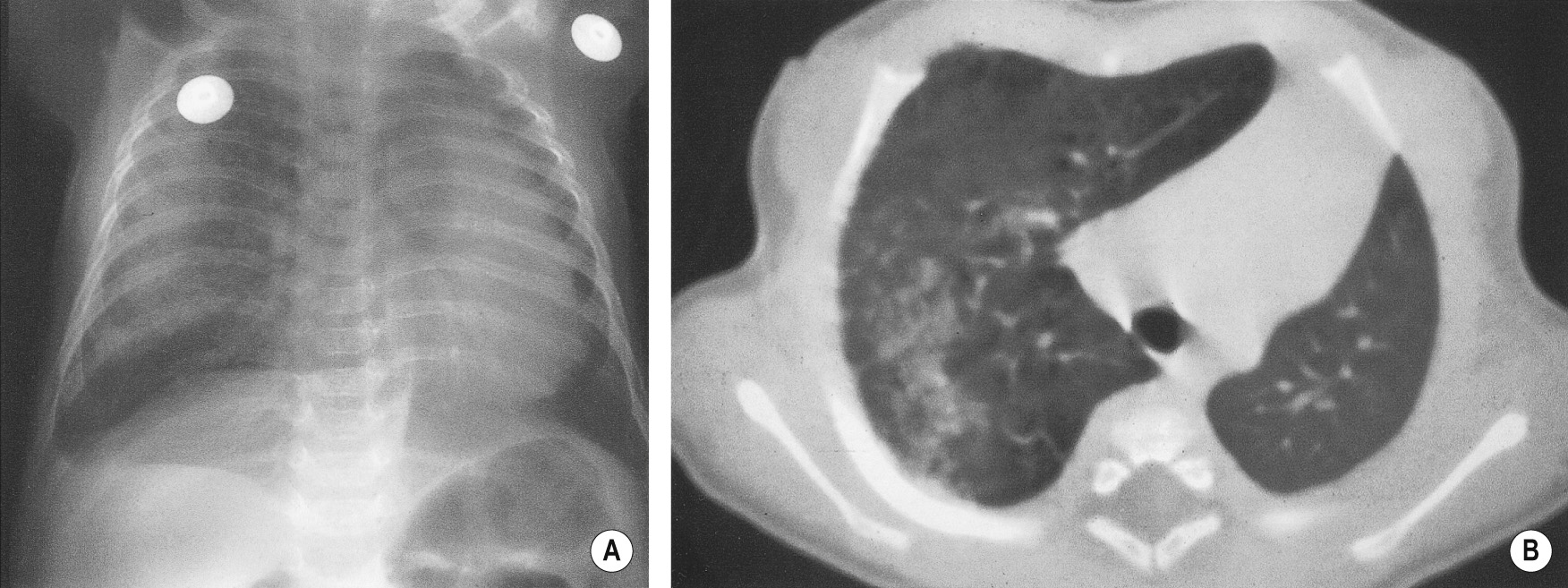 CCAM type 3. (A) CXR demonstrating extensive ground-glass opacification with gross overinflation of the right lung and herniation across the midline. (B) CT again demonstrates overexpansion of the right lung with ground-glass shadowing due to microcysts beyond CT resolution. †