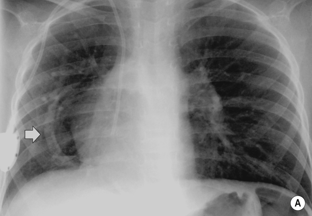 Congenital venolobar syndrome (scimitar syndrome). (A) CXR showing (1) shift of the heart into the right hemithorax, (2) a small right lung with an abnormal vessel (arrow) paralleling the right heart border and (3) overinflation (compensatory) of left lung. (B) Coronal CT reformat highlights the abnormal ‘scimitar vein’ (arrow) draining below the diaphragm into the systemic venous system bypassing the pulmonary veins. **