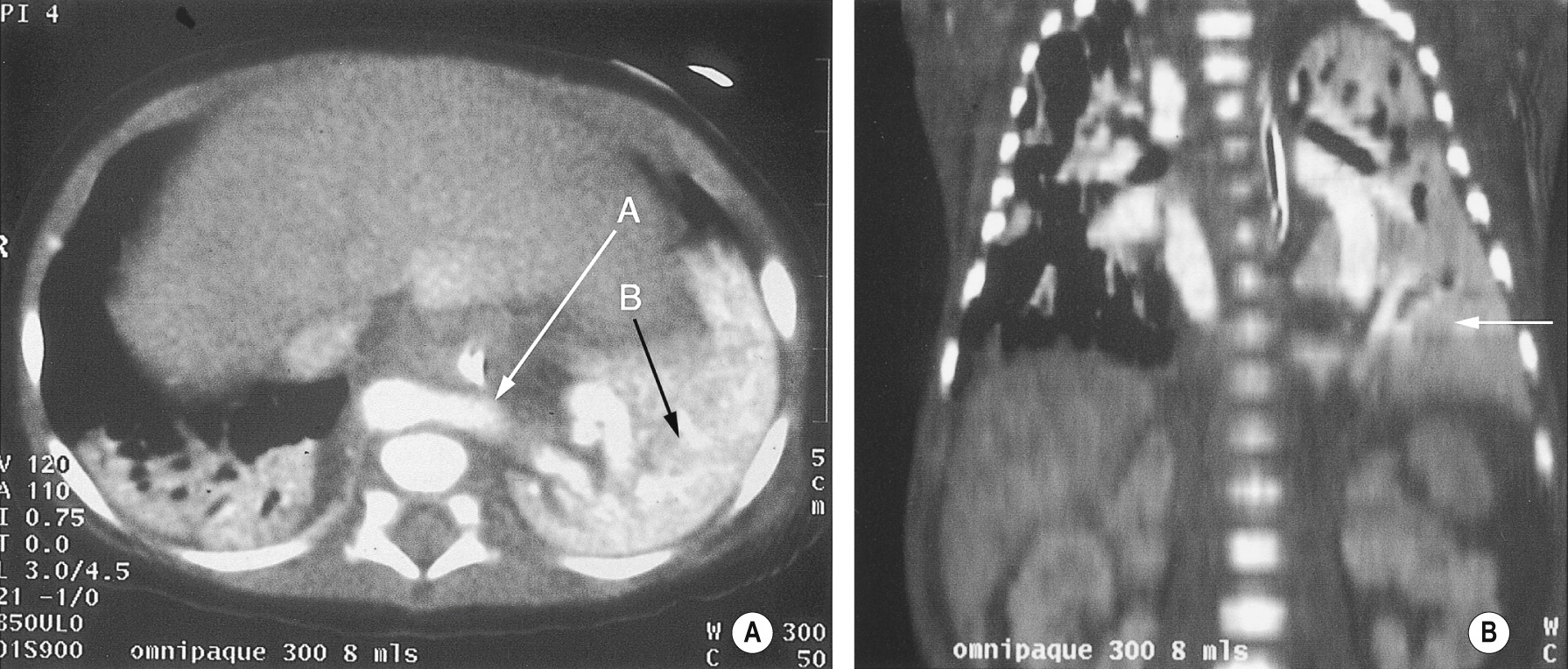 (A) Axial CECT through the lung bases with a large systemic vessel arising from the left side of the aorta (arrow A) supplying a very vascular left-sided extralobar sequestration (arrow B). (B) Coronal CT showing the normal lung and beneath this (arrow) the left-sided basal extralobar sequestration with a draining vein entering the azygous system below the diaphragm. †