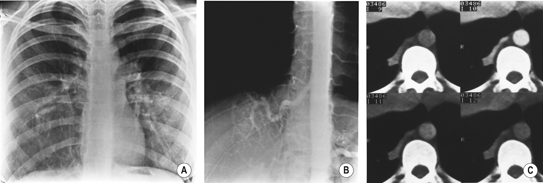 Intralobar sequestration (air-filled). (A) PA CXR. The pulmonary vessels at the right base display an abnormal course ▸ this suggests they may be draped around a space-occupying but air-filled lesion. The right hemidiaphragm is slightly depressed and the heart is shifted slightly to the left. (B) Aortogram demonstrates a large single vessel arising from the distal aorta supplying a portion of the right lower lobe. (C) CECT confirms the vascular supply.