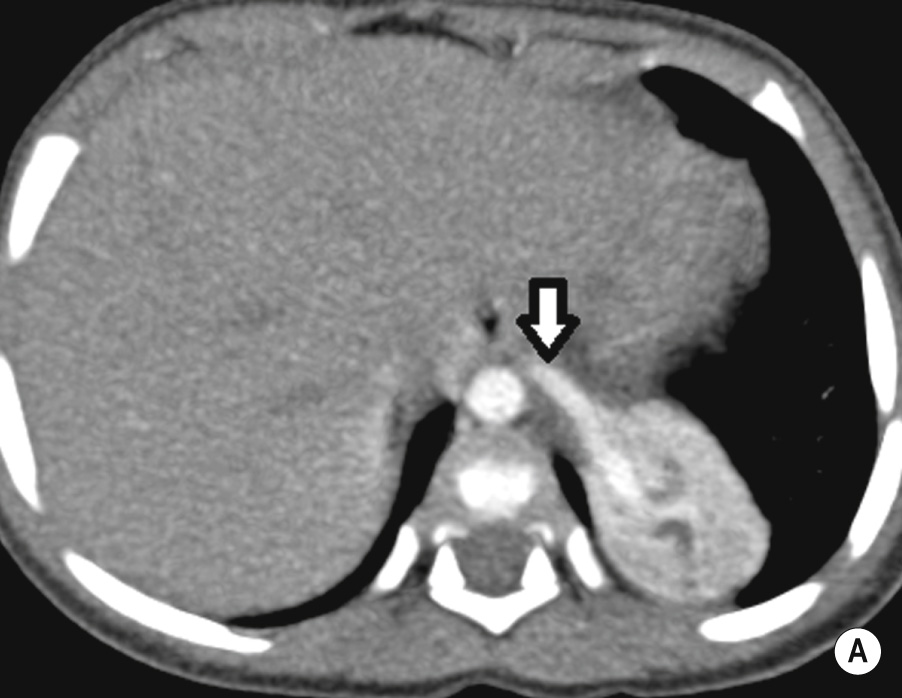 Pulmonary sequestration. (A) Axial CT shows an enhancing mass in the posterior left lower lobe with a large (enhancing) feeding vessel (arrow). (B) Oblique coronal reformat highlights the mass receiving arterial supply from a branch of the coeliac artery (arrow) with venous drainage occurring via a left pulmonary vein (arrowhead). **