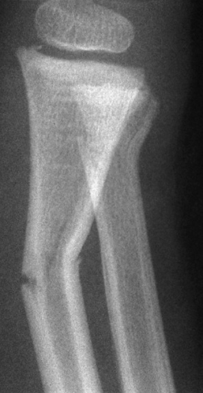 Greenstick fractures of the distal radius and ulna. *