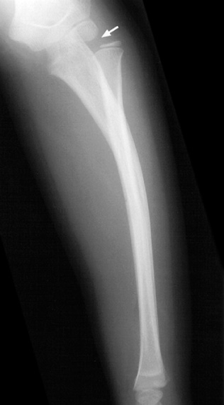 Plastic bowing of the ulna with dislocation of the radial head (arrow). *
