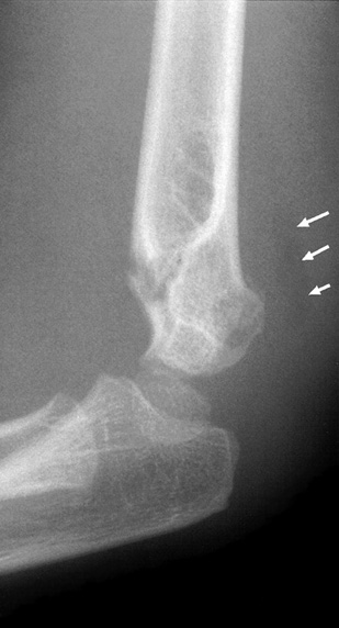 Supracondylar fracture of the distal humerus with elevation of the posterior fat pad (arrows). The mid ⅓ of the capitellum is also displaced posterior to the anterior humeral line. *