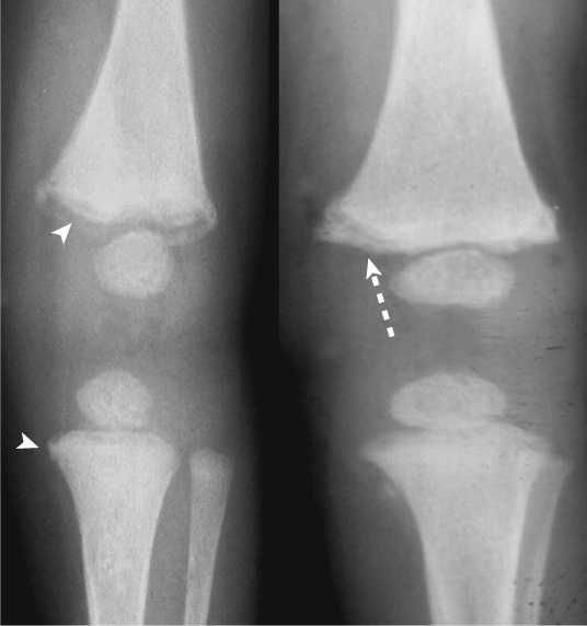 Classic metaphyseal lesions with different appearances. ‘Corner fracture’ (a thick rim only, arrowhead), ‘bucket handle’ (a thick rim projected away from the shaft, arrow) and a thin disk with a thick rim (stippled arrow). **