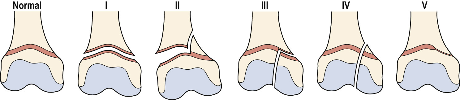 Illustration of the Salter–Harris classification of fractures. (Type I) The fracture is isolated to the growth plate and causes epiphyseal separation, without adjacent bone fracture. The fracture line passes through the hypertrophic layer of the physis. (Type II) This is the most common growth plate fracture and is usually seen in children between the ages of 10 and 16. As a result of shearing or avulsive force, the fracture splits the growth plate and then passes into the metaphysis, separating a small fragment of bone. (Type III) The fracture line passes through the epiphysis, and then horizontally across the growth plate. This is most commonly seen at the distal tibia in children aged 10–15. (Type IV) This is a vertically orientated fracture, involving both the epiphysis and metaphysis, and crossing the growth plate. This is most commonly seen in the distal humerus and tibia. (Type V) This fracture, results from a compressive force, crushing the growth plate. Damage to the growth plate can cause subsequent deformity. The diagnosis is often made retrospectively when growth arrest is discovered at a later date. **