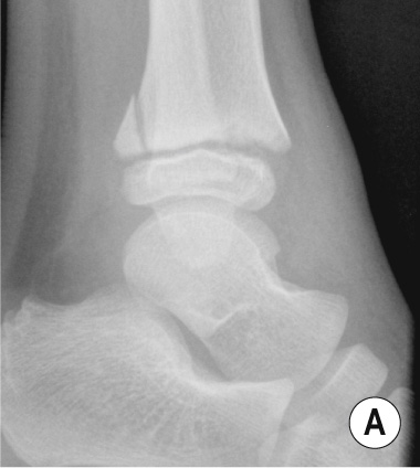 Various Salter–Harris fractures. (A) Salter–Harris II fracture of the distal left tibia. (B) Salter–Harris III fracture of the distal right tibia. (C) Salter–Harris fracture of the distal left tibia. **