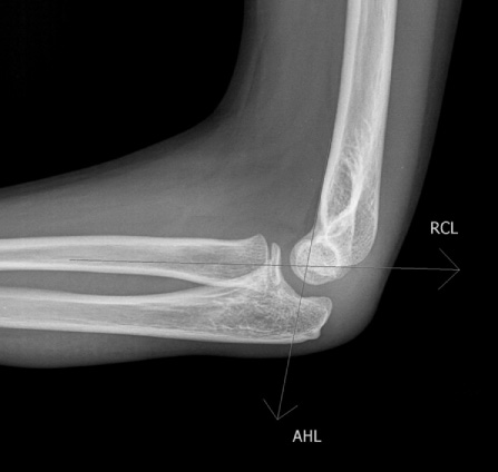 Normal lateral film of the elbow. The two lines drawn on the radiograph are used to assess the elbow joint. Anterior humeral line (AHL): one-third of the capitellum should lie anterior to this line. In the young child where there is only partial ossification of the capitellum, this measurement is less valid. RCL—on a lateral film, a line drawn along the shaft of the proximal radius should pass through the capitellum. **