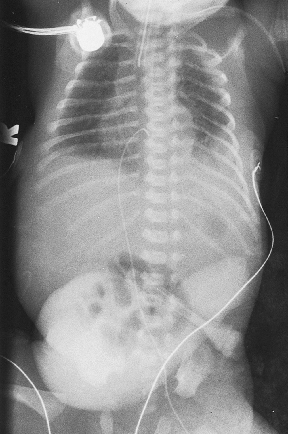 Gastroschisis. Several air-filled extra-abdominal loops of bowel are seen in this infant of 26 weeks' gestation. A small left congenital diaphragmatic hernia was also present. †