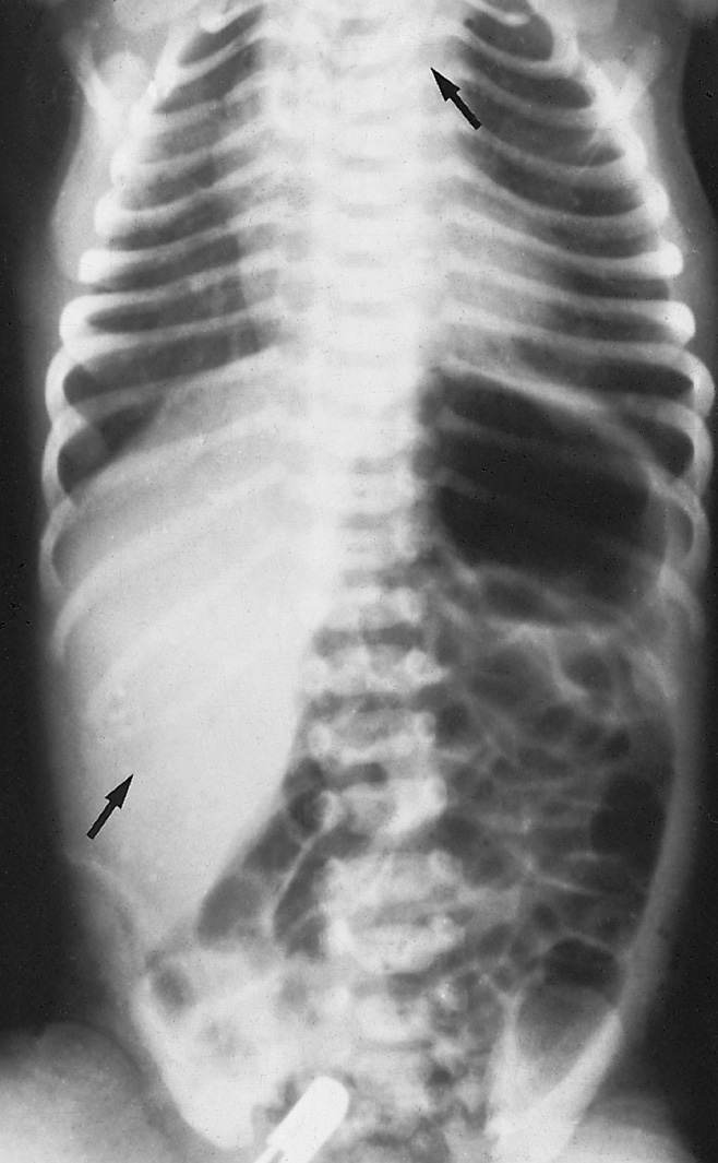 OA with TOF. A coiled nasogastric tube is seen in the dilated proximal oesophageal pouch (top arrow). The presence of distal air-filled bowel implies an associated TOF. Thirteen pairs of ribs are noted, compatible with VATER syndrome (lower arrow).