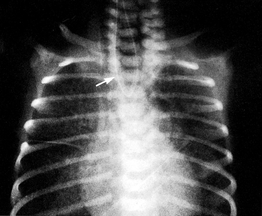 Oesophageal atresia. Supine CXR shows orogastric tube (arrow) curled in the proximal oesophageal pouch. *