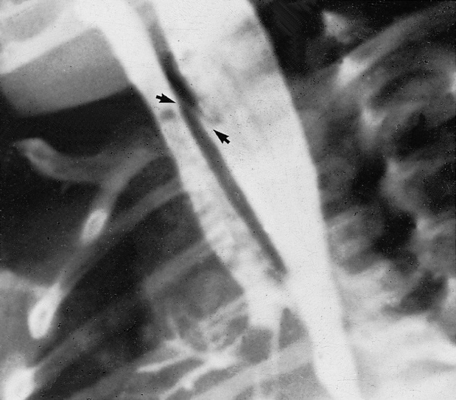 Contrast oesophagram demonstrating oblique track (arrows) of a TOF with contrast filling the tracheobronchial tree. †