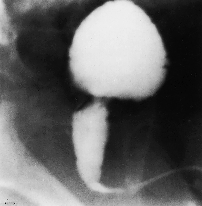 Prune belly syndrome. Image exposed near the end of micturition on a voiding cystourethrogram. The posterior urethra is dilated proximal to the membranous urethra and the calibre of the latter is normal. Posterior urethral valves are not present. *