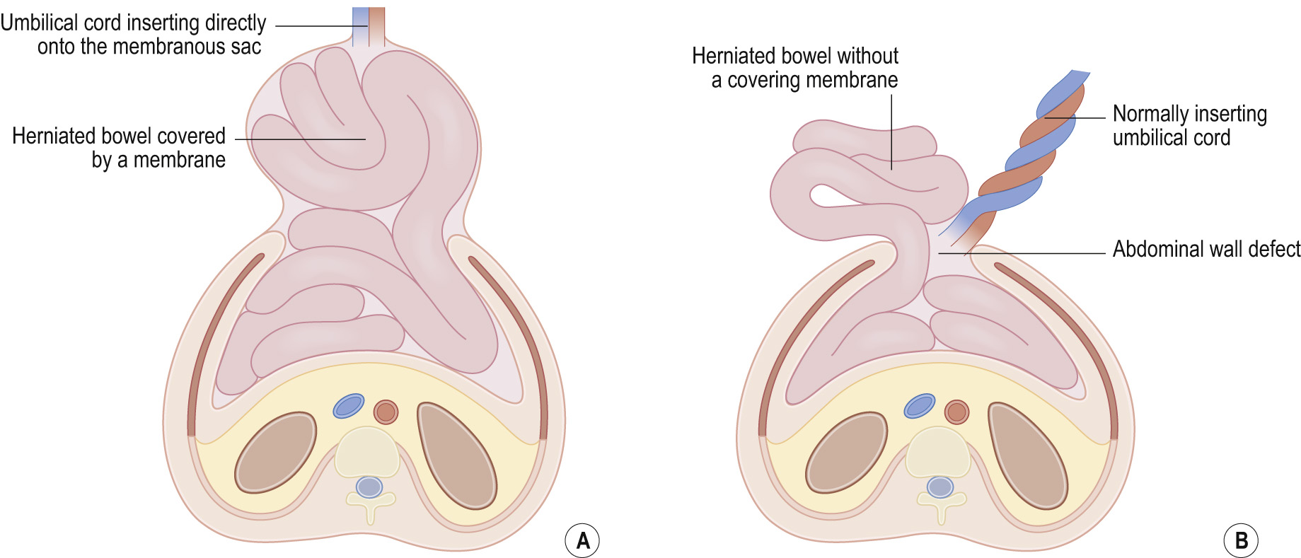 (A) Omphalocele. A midline abdominal wall defect with herniated bowel covered by a membrane. The umbilical cord inserts directly onto the herniated membranous sac. (B) Gastroschisis. The abdominal wall defect is adjacent to a normally inserted umbilical cord. The herniated bowel is not covered by a membrane.