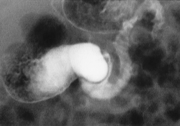 Duodenal web. Barium meal demonstrating a curvilinear filling defect or ‘wind-sock diverticulum’ in the second part of the duodenum with proximal dilatation. †