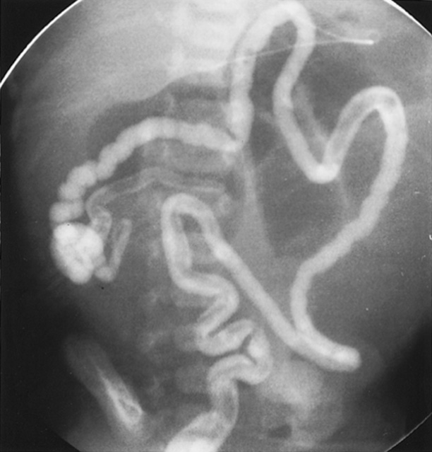 Ileal atresia. Contrast enema with microcolon and reflux into a non-dilated distal ileal segment with abrupt convex termination. A few meconium plugs are present. †