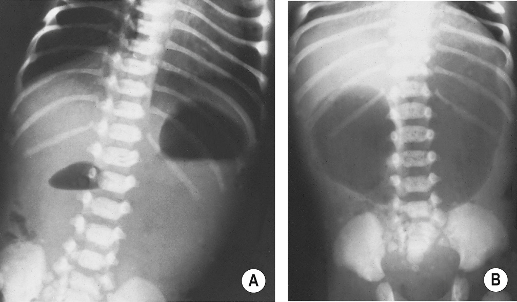 Duodenal atresia. Erect (A) and supine (B) AXR demonstrating the classic ‘double bubble’ sign. *