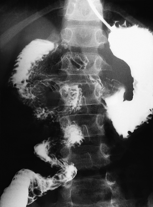 Malrotation and volvulus. Upper GI contrast medium study demonstrates the classical ‘corkscrew’ pattern of the duodenum and jejunum spiralling around the mesenteric vessels. *