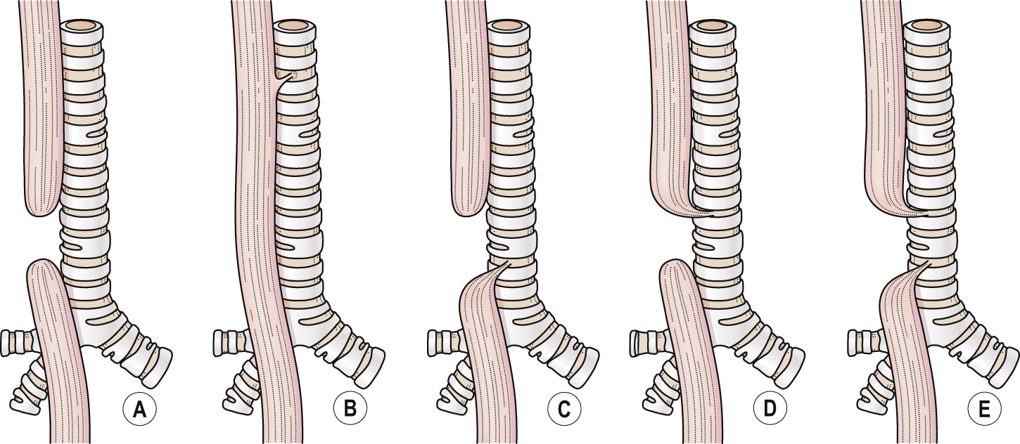 Oesophageal atresia and tracheo-oesophageal fistula. Diagrammatic representation of (A) isolated OA (9%), (B) H-type fistula (6%), (C) OA with distal TOF (82%), (D) OA with proximal TOF (1%) and (E) OA with TOF from both proximal and distal oesophageal remnants (2%). **