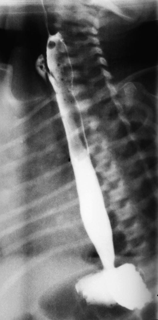 H-type TOF. Upper GI contrast study shows the fistula running obliquely at the level of the thoracic inlet. *