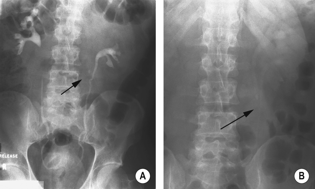 The classical ‘drooping lily’ sign on IVU (A). The lower pole moiety has been displaced inferolaterally by an upper pole hydronephrosis. This usually occurs due to obstruction of the upper pole moiety ureter at its orifice associated with an ectopic insertion or a ureterocele. (B) In this case it is due to a calculus in the upper pole moiety ureter (arrow). †