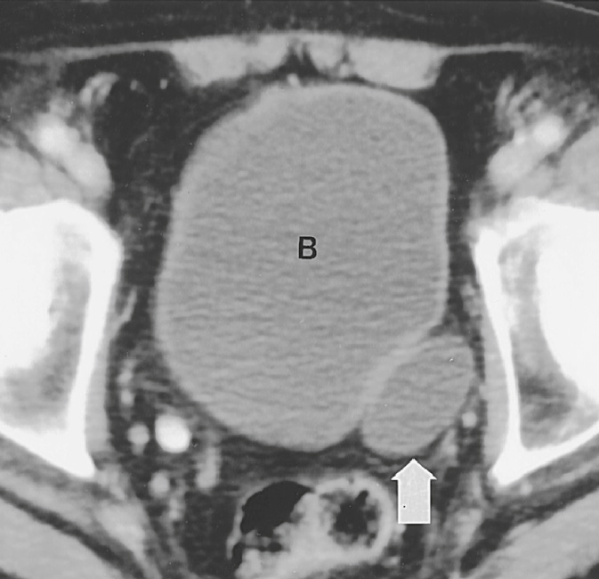A seminal vesicle cyst (arrow) adjacent to the bladder (B) in a patient with unilateral renal agenesis. ∫