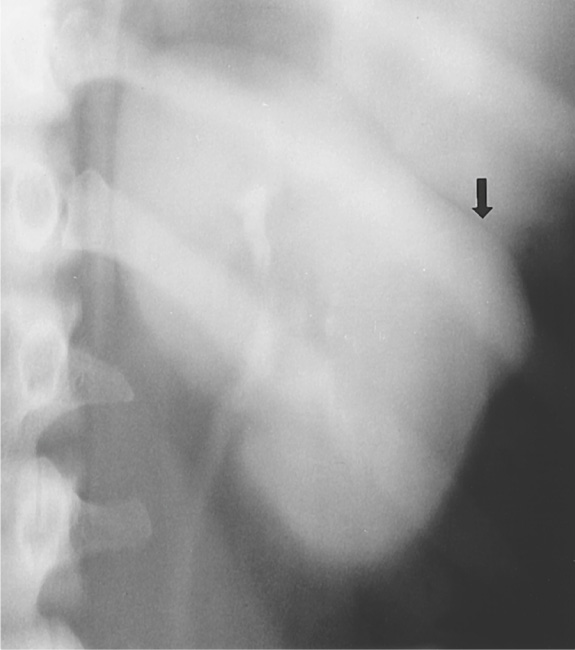 Dromedary hump. A nephrogram demonstrates a focal convex bulge (arrow) along the lateral margin of the left kidney, thought to be due to splenic impression on the kidney. ∫