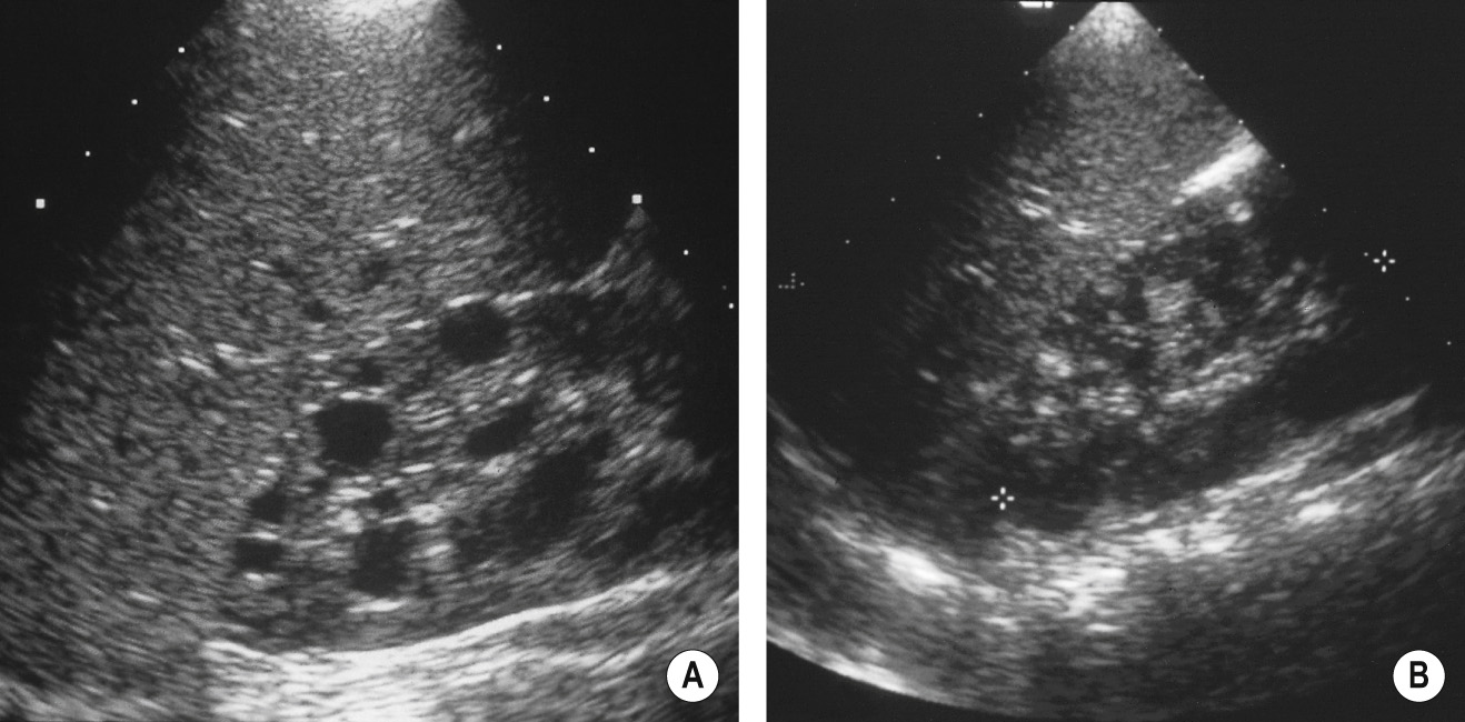 Tuberous sclerosis. (A) Longitudinal US of the right kidney. The left kidney had similar appearances. Both kidneys contain multiple cysts of varying sizes. The appearances on US are indistinguishable from autosomal dominant polycystic kidney disease. This child had the skin stigmata of tuberous sclerosis. (B) Longitudinal US of the right kidney of another patient. There were similar appearances in the left kidney. This shows the more usual appearances of tuberous sclerosis in the kidney with the small echogenic foci of angiomyolipomas. *