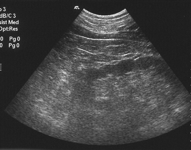 Renal US demonstrating the characteristic pattern of persistent fetal lobulation.