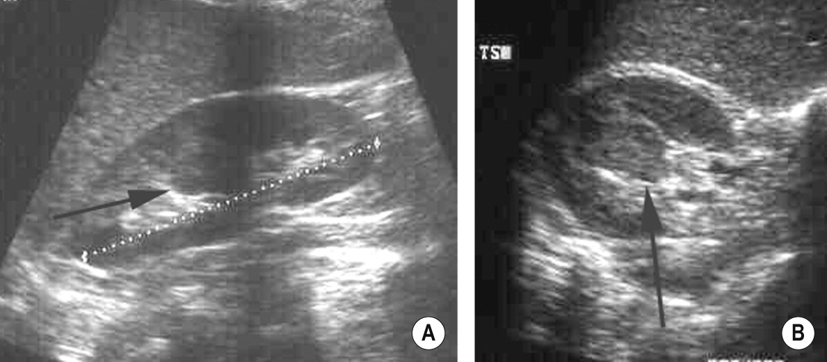 Septum of Bertin. Longitudinal (A) and transverse (B) scans (arrows). †