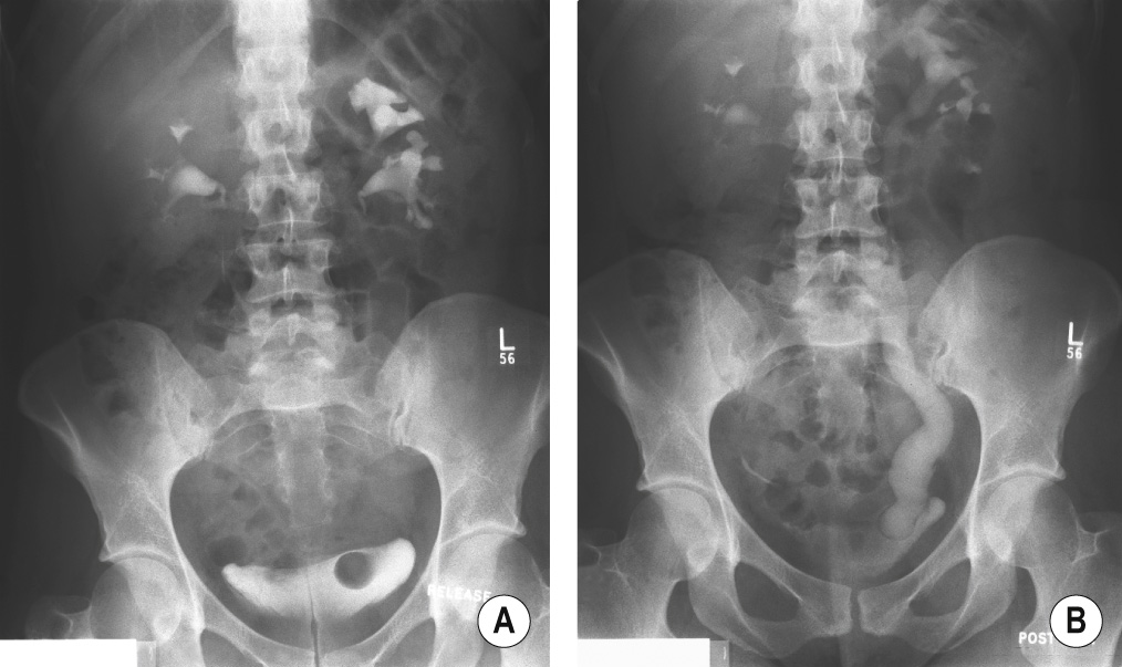 Full-length film from an IVU series showing a non-opacified partly obstructing ureterocele surrounded by opacified urine in the bladder (A). A later full-length film shows opacification of the distended upper moiety ureter running down to the opacified ureterocele (B). †