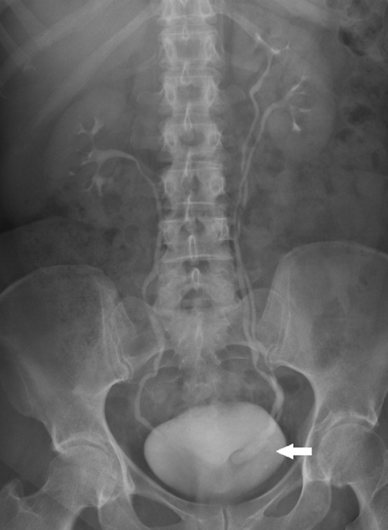 IVU demonstrating a duplex left kidney with complete ureteric duplication. The upper moiety ureter is seen entering the bladder as a ureterocele with a typical ‘cobra's head’ appearance (arrow).