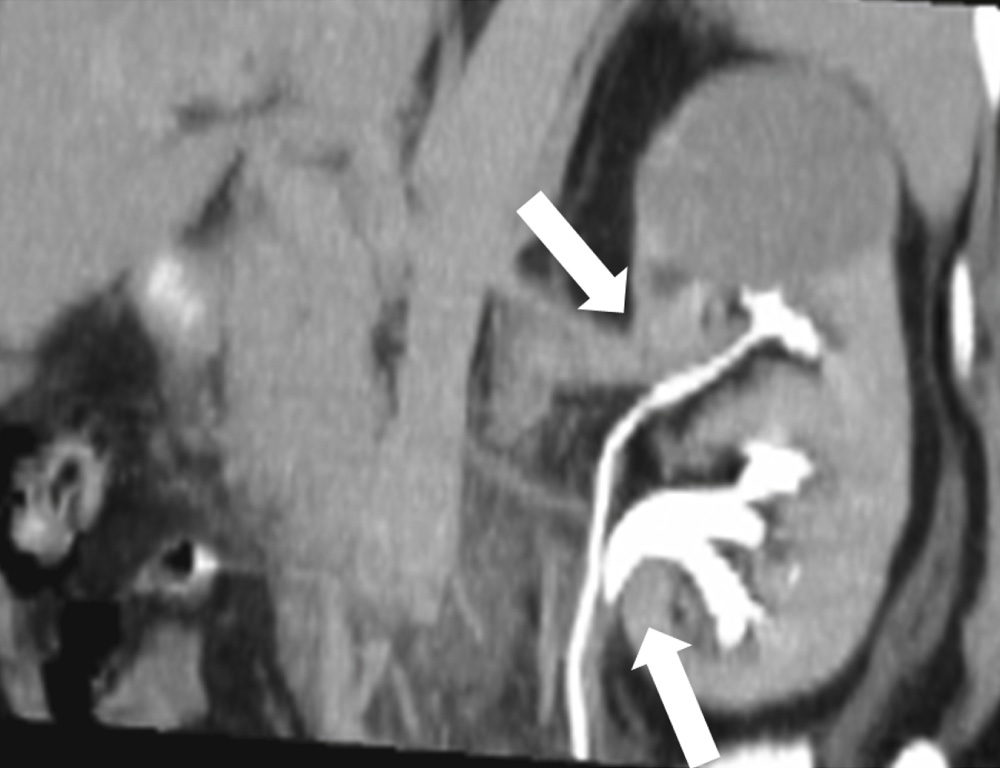 Partial duplication of the left renal collecting system on CT in a 61-year-old woman. Coronal CT reformation shows separate drainage systems for the upper and lower moieties of the left kidney (arrows). **