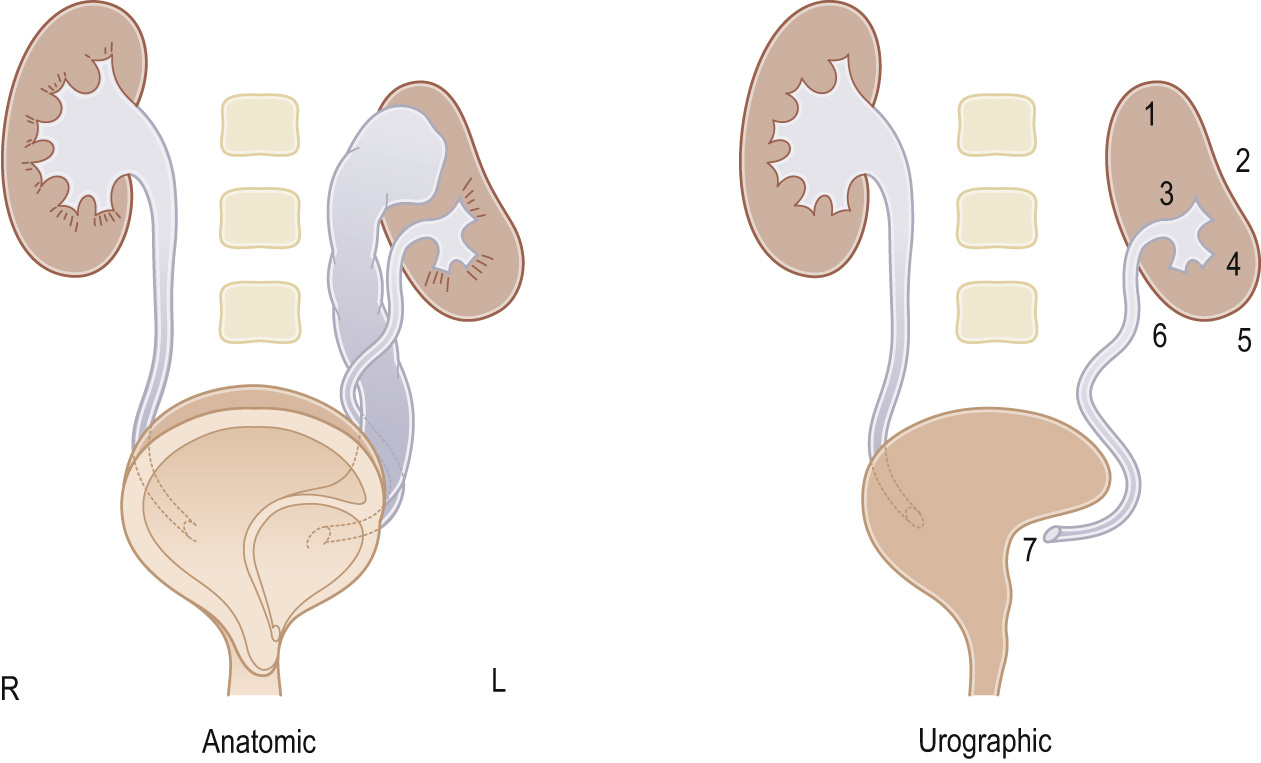 Ectopic ureterocele. Diagrammatic representation of the anatomical and urographic appearances of an ectopic ureterocele of the left upper moiety without function. Diagnosis of this entity on IVU depends on recognition of indirect signs: 1, increased distance from the top of the visualized collecting system to the upper border of the nephrogram ▸ 2, abnormal axis of the collecting system ▸ 3, impression upon the upper border of the renal pelvis ▸ 4, decreased number of calyces compared to the contralateral kidney ▸ 5, lateral displacement of the kidney and ureter ▸ 6, lateral course of the visualized ureter ▸ 7, filling defect in the bladder.