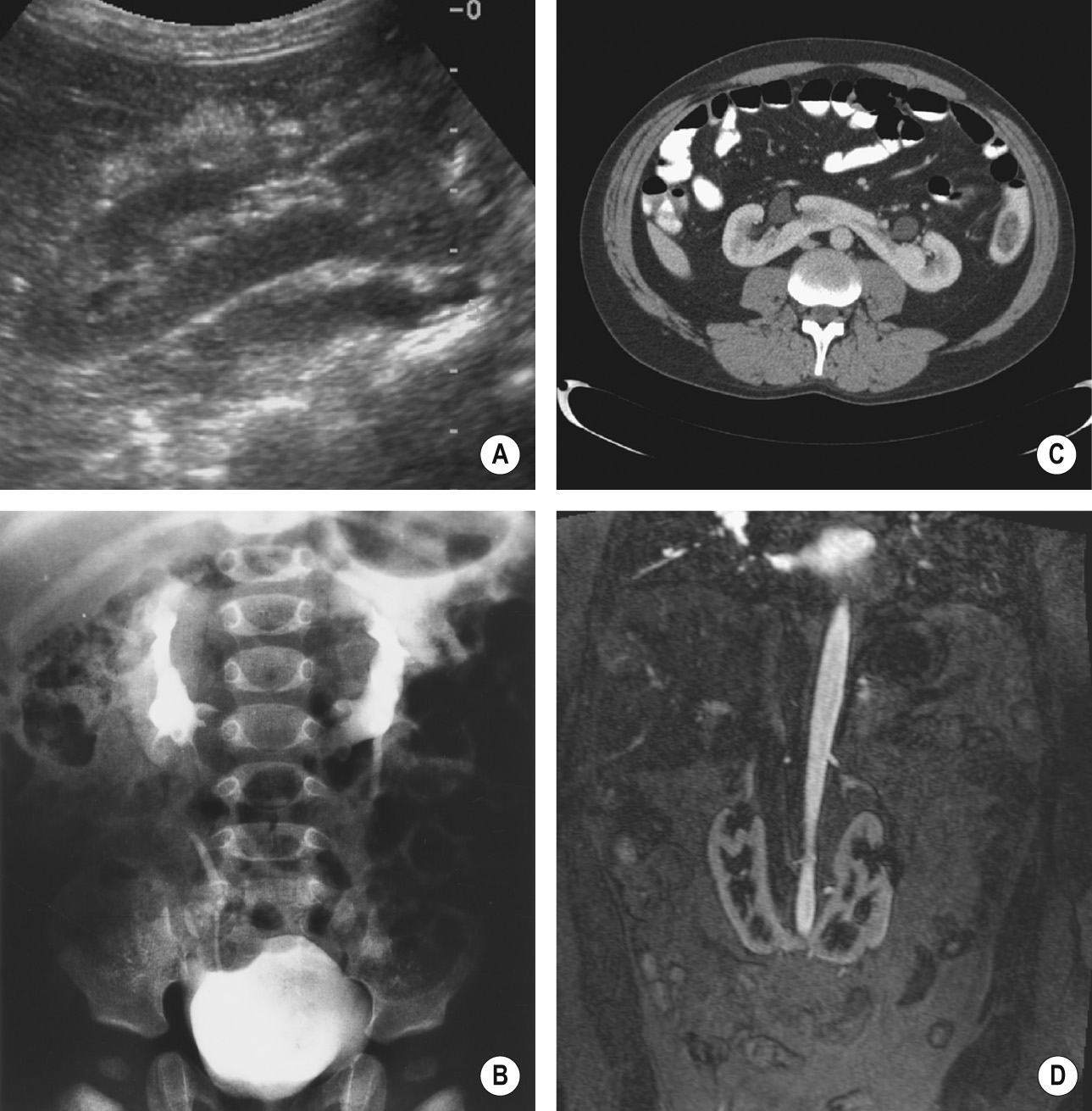 Horseshoe kidney. (A) Longitudinal US. (B) Axial CT image. (C) IVU demonstrating lower renal poles merging inferomedially. (D) T2WI MR urogram. §,†