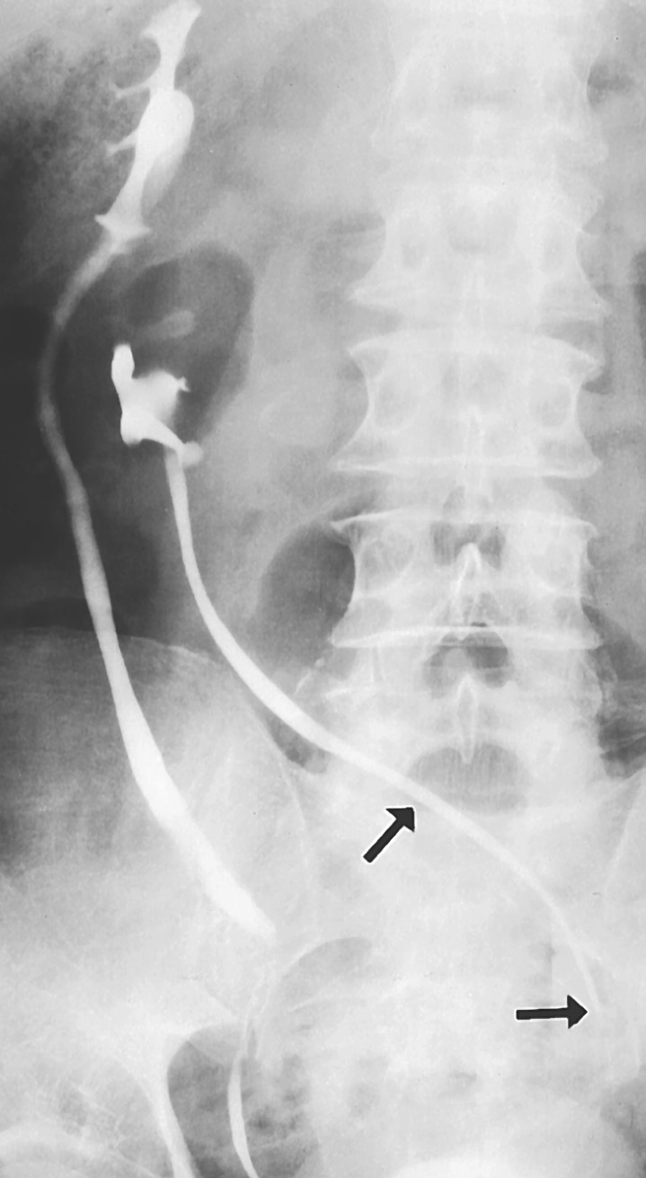 Cross-fused ectopia demonstrated on IVU. The abnormally positioned left kidney still drains into the left VUJ (arrows). ∫