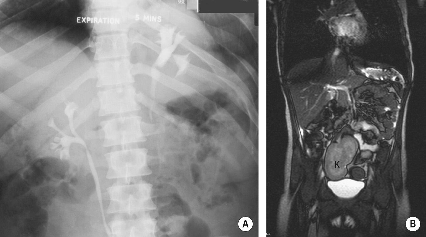 Ectopic kidneys. An intrathoracic kidney seen on IVU (A). (B) Coronal T2WI demonstrating a pelvic kidney (K). †,§