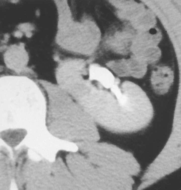 Renal malrotation. CT demonstrating a malrotated kidney with the renal pelvis draining the kidney anteriorly rather than the normal medial position. ∫