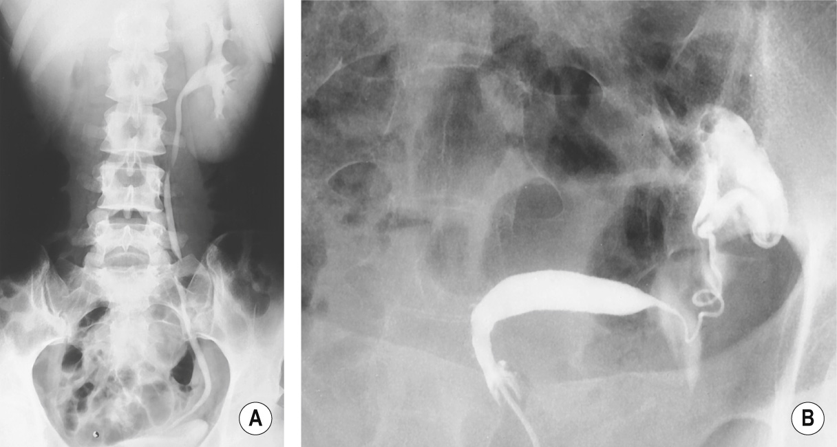 Unicornuate uterus associated with unilateral renal agenesis. (A) IVU demonstrating agenesis and compensatory hypertrophy of the remaining kidney. (B) Hysterosalpinography demonstrates a left-sided unicornuate uterus. ∫