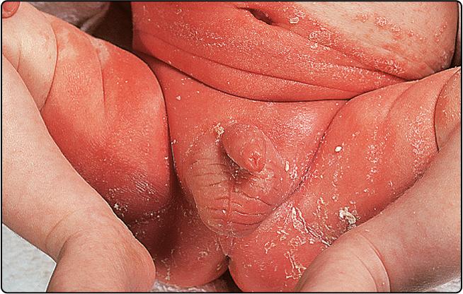 Fig. 66.2, Infantile seborrhoeic eczema.